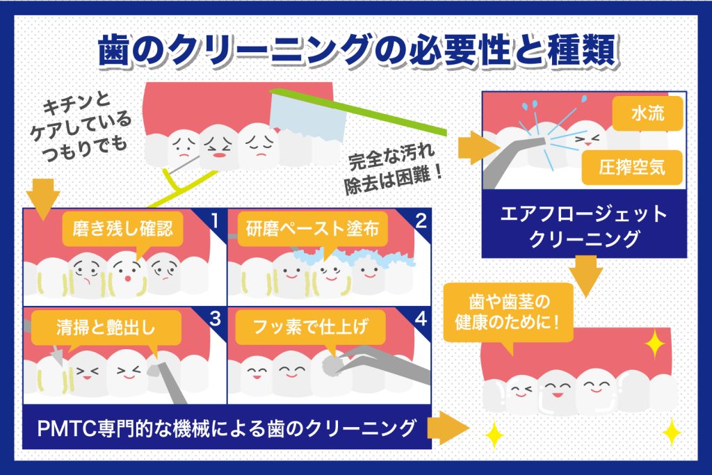 歯のクリーニングの必要性と種類