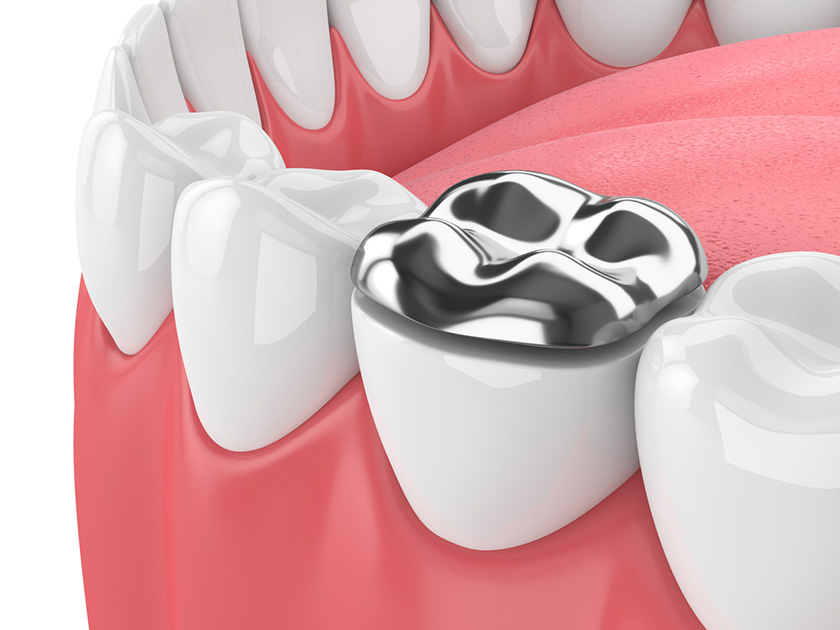 審美歯科で使われる素材の特徴やメリットと注意点とは