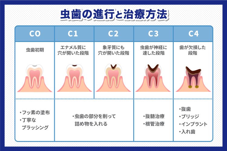 虫歯の進行と治療方法