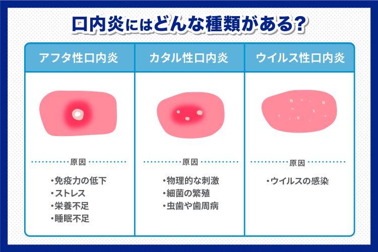 口内炎にはどんあ種類がある？