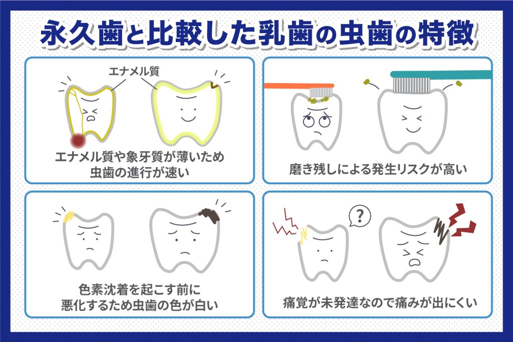 永久歯と比較した乳歯の虫歯の特徴