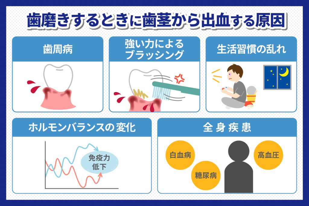 歯磨きで出血するのはなぜ？　原因や対処法を解説