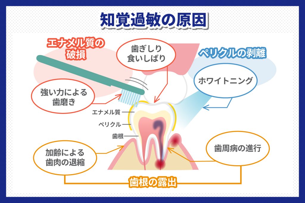 知覚過敏