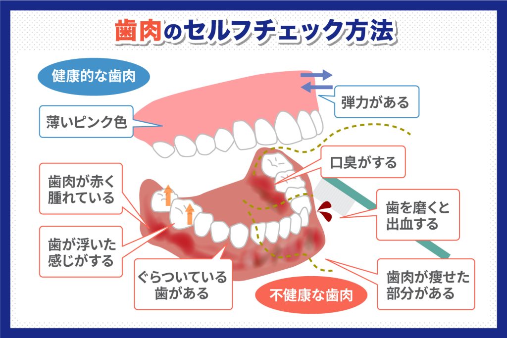 歯肉のセルフチェック方法