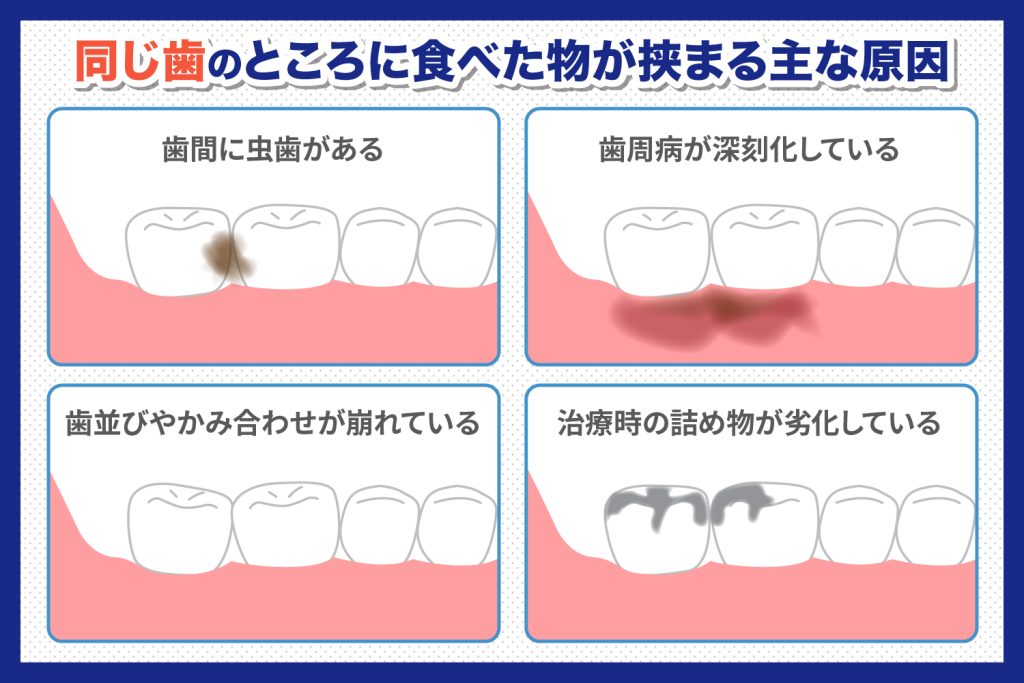 同じ歯のところに食べた物が挟まって困る！　なぜなの？