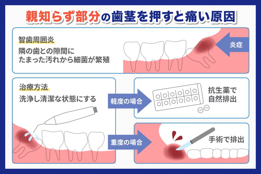 親知らずが生えている歯茎を押すと痛いのは何が原因？ 