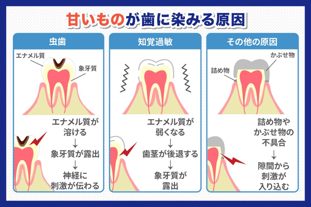 チョコレートなどの甘いものが歯に染みる原因