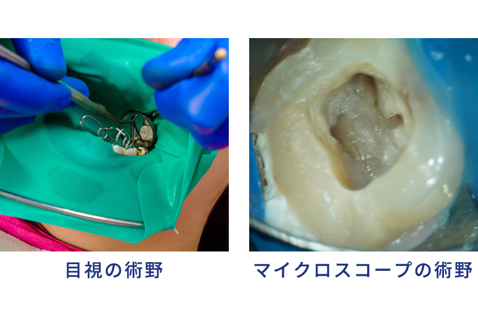 細菌の除去率がポイント