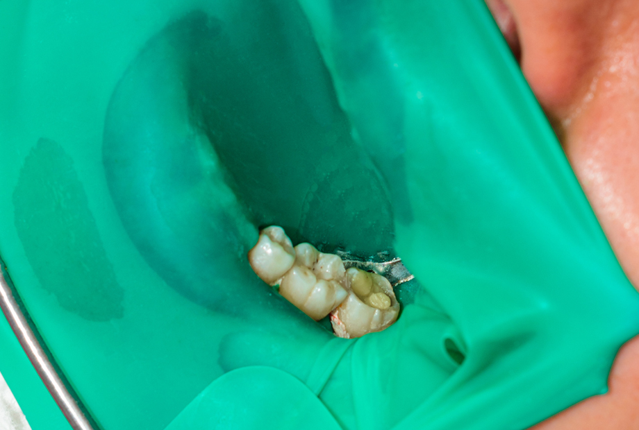 ラバーダムで無菌環境での治療