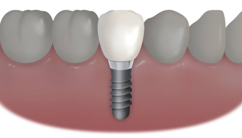歯を1本失った方のインプラント