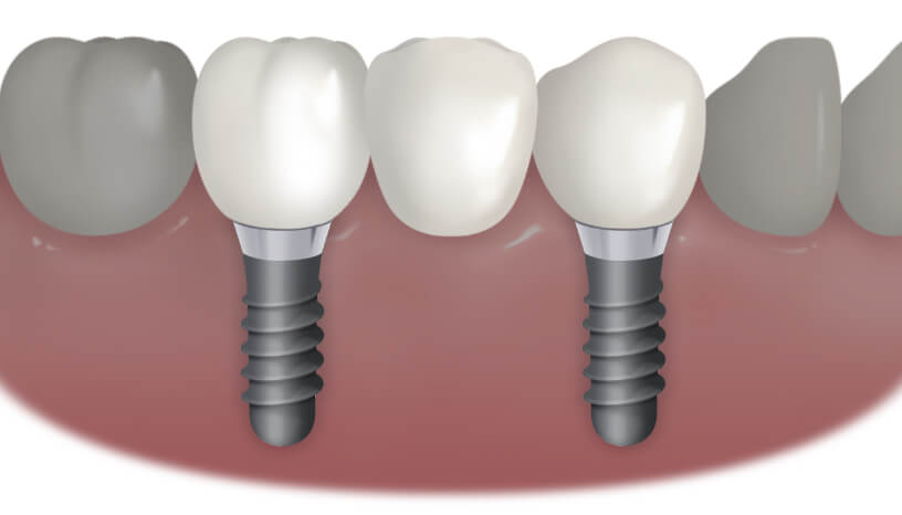 歯を3本失った方のインプラント