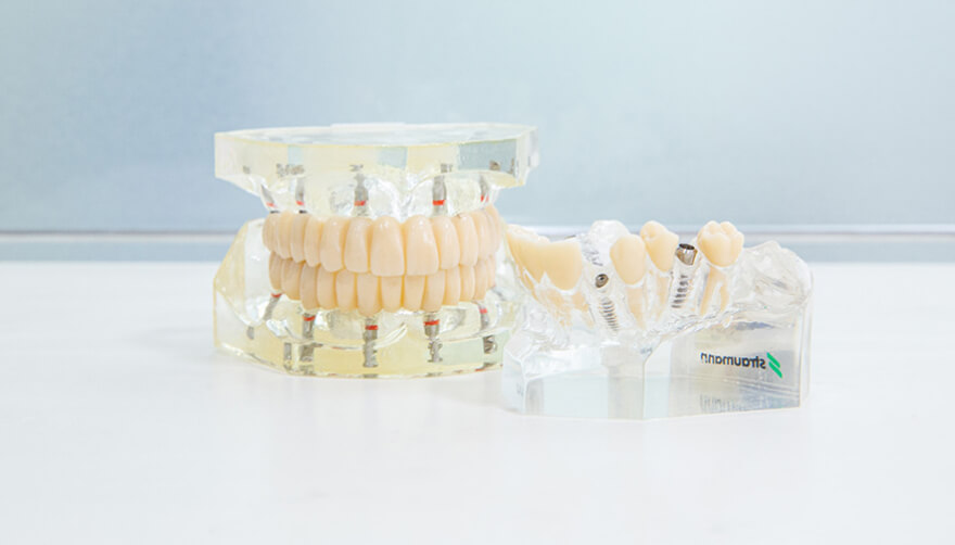 インプラント写真