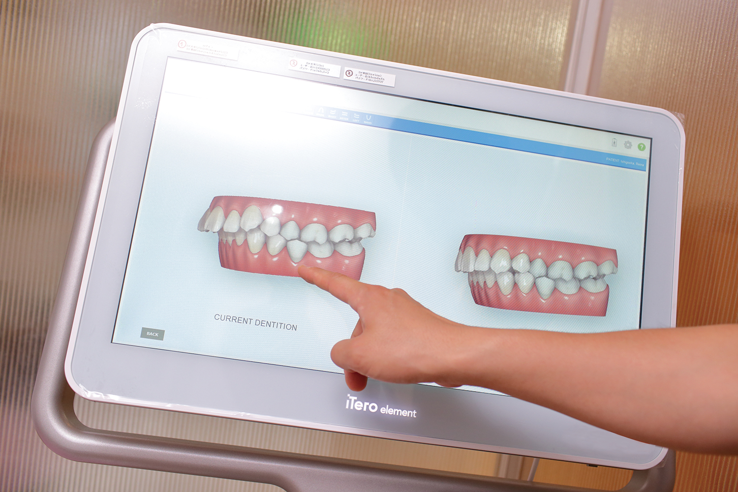 3Dシミュレーションで治療後の歯並びが分かるから安心