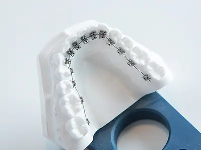 裏側矯正