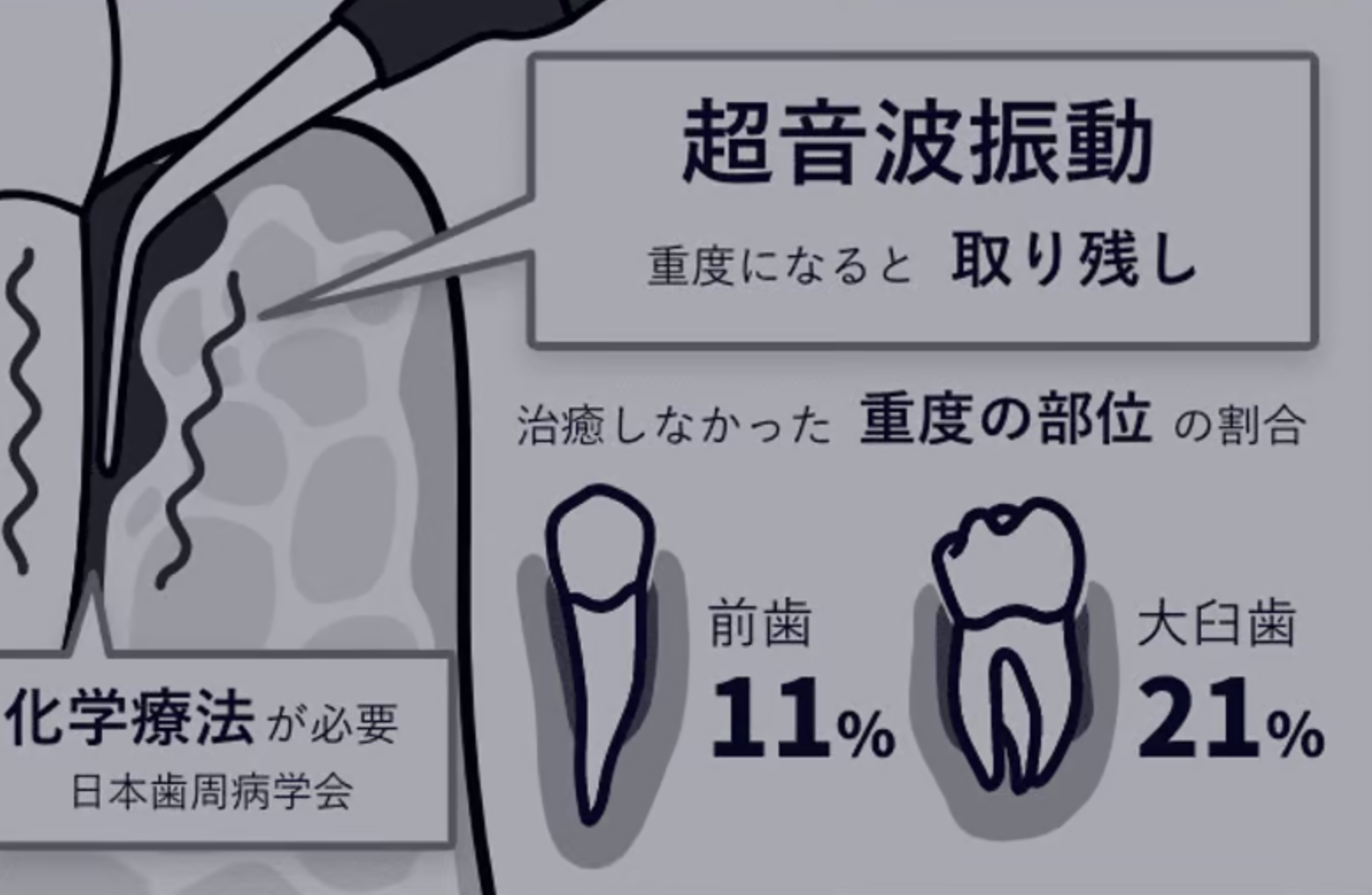 従来の治療法｜超音波振動のみ