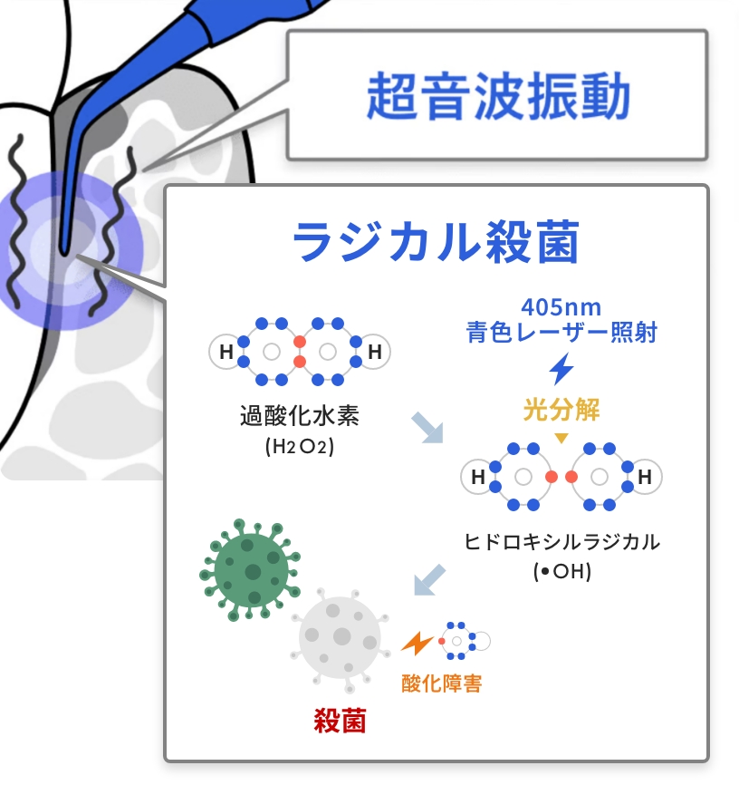 ブルーラジカル治療｜過酸化水素分解殺菌技術（超音波振動 + ラジカル殺菌）